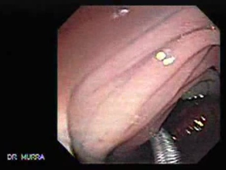 Colonoscopic Polypectomy (10 of 23)