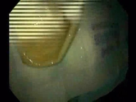 Endoscopic Balloon Removal (9 of 9)