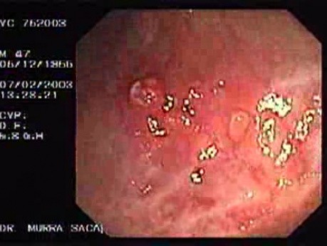 Ulcerative Colitis Of Long Stand Evolution (1 of 3)
