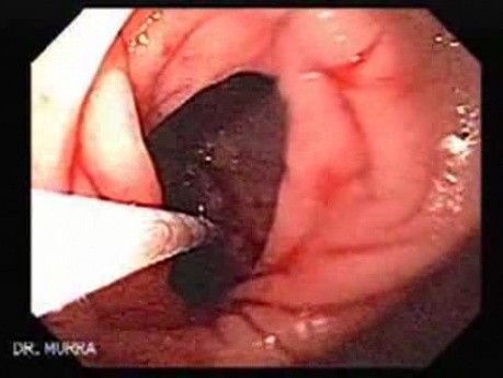 Duodenal Ulcer and Bleeding (20 of 23)
