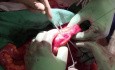 Continent Catheterizable Ileal Cecocystoplasty 