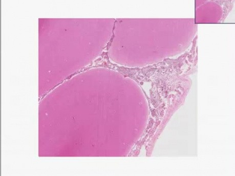 Acute pyogenic (bacterial) meningitis