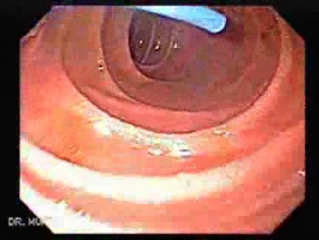 The Black Esophagus - Biliary Plastic Stent, Part 1