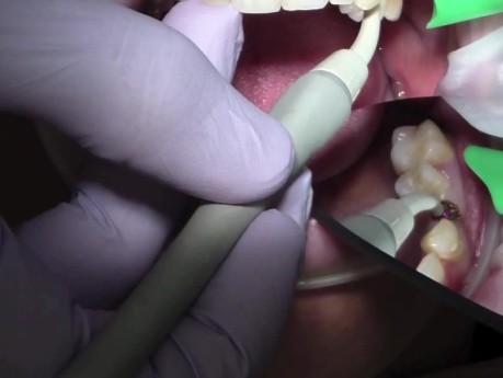 Ivoclar Odyssey Navigator Dental Laser