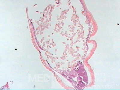 Trichuris Trichuris (whipworm) (11 of 19)