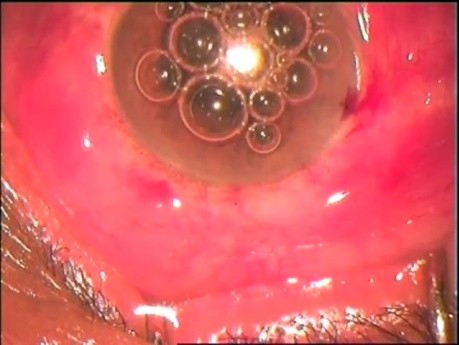 Phakoemulsifikation And Microciliary Filtration
