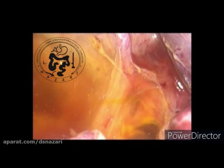 Laparoscopic CBD Exploration, ERCP Baloon for impacted Stone Extraction