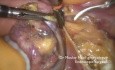 Adnexectomy on Post Menopausal Ovarian Teratoma 