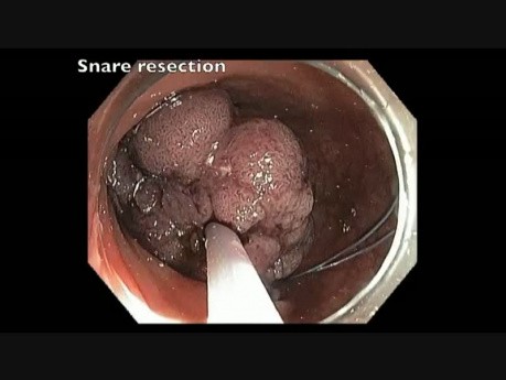 Sigmoid Colon - Giant Pedunculated Polyp Resection