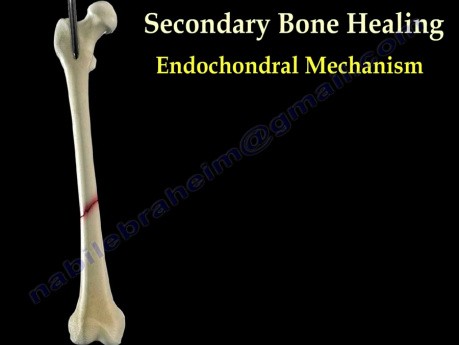 Fracture Healing  - Video Tutorial - Part 2