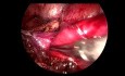 Transperitoneal Laparoscopic Ureteropyeloplasty of Retrocaval Ureter