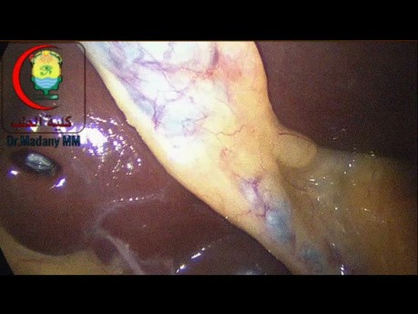 Total Riedel's Lobe is it Difficult Nassar Grade I, Where is the Insertion of Cystic Duct in Relation to Rouvier Sulcus