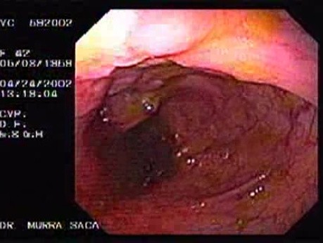 Crohn's Disease - Endoscopy (6 of 28)