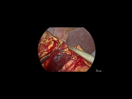 Laparoscopic Radical Right Hemicolectomy with Mesocolic Excision