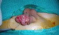 Penis Injury  Another  Intra-Operative Photo