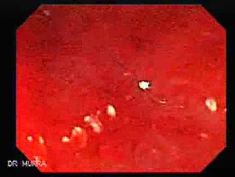 Colonoscopic Polypectomy (2 of 23)