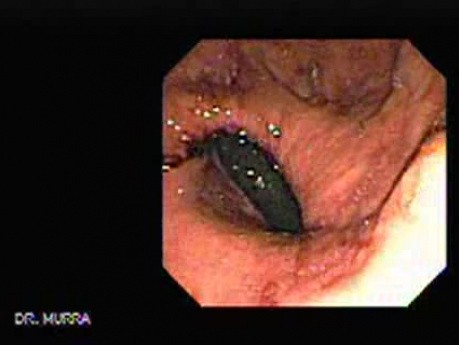 The Gastric Cardia (4 of 6)