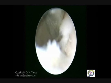 IUA Asherman Sy  Excision Of Adhesions  Using Cold Scissors