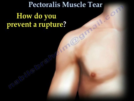 Pectoralis Muscle - Tendon Tear 