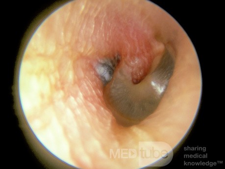 Herpes Zoster of the External Canal and Tympanic Membrane