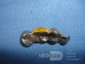 Dental Prothesis Found in the Jejuno (6 of 9)