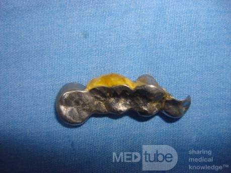 Dental Prothesis Found in the Jejuno (6 of 9)