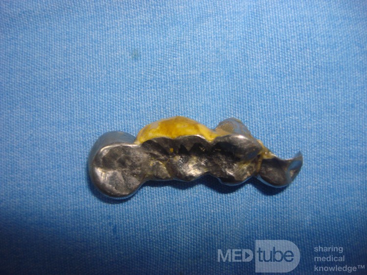 Dental Prothesis Found in the Jejuno (6 of 9)
