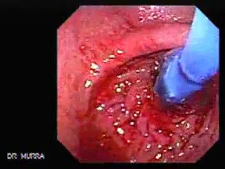 Esophageal Achalasia (7 of 10)