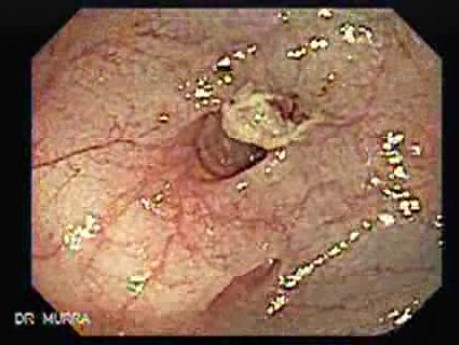 Polyp Inside Of A Diverticulum (6 of 12)