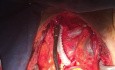 Concomitant CABG and Innominate Artery Bypass