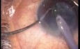Cataract Surgery - Horizontal Chopping