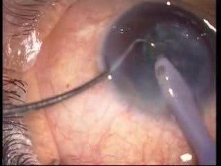 Cataract Surgery - Horizontal Chopping