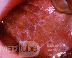 Lichen Planus [non-erosive, buccal mucosa)
