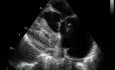 Pulmonary Embolism