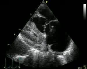 Pulmonary Embolism