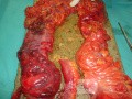 Multiple Rectal Ulcers (75 of 110)
