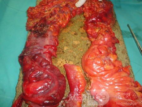 Multiple Rectal Ulcers (75 of 110)