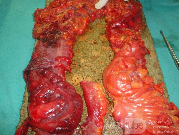Multiple Rectal Ulcers (75 of 110)