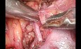 Laparoscopic Partial Nephrectomy During Pregnancy