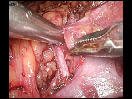 Laparoscopic Partial Nephrectomy During Pregnancy