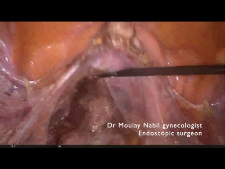 Standart sacrocolpopexy for urogenital prolapse
