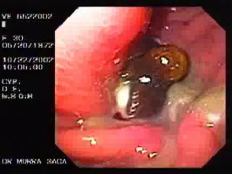 Gastric Cancer - Perzzev Catheter