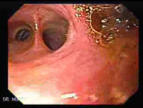 Choledocoduodenostomy and The Sump Syndrome (1 of 10)