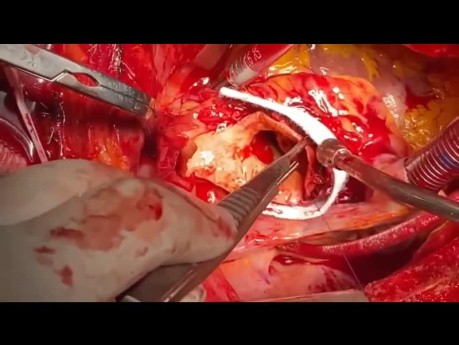Patient with Ascending Aorta 20 cm Aneurysm