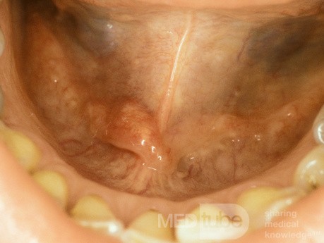Submandibular Duct Stone