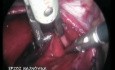 Left Pleura Rupture During Laparoscopy