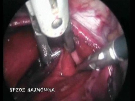 Left Pleura Rupture During Laparoscopy