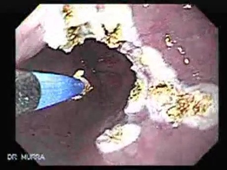 Barrett's Esophagus of long segment (7 of 11)