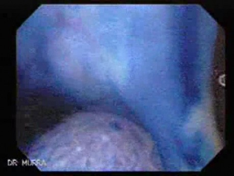 Non Familial Juvenile Polyposis Of The Colon (22 of 37)