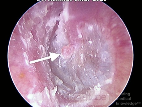 Keratinosis of Ear Canal with Umbo Polyp